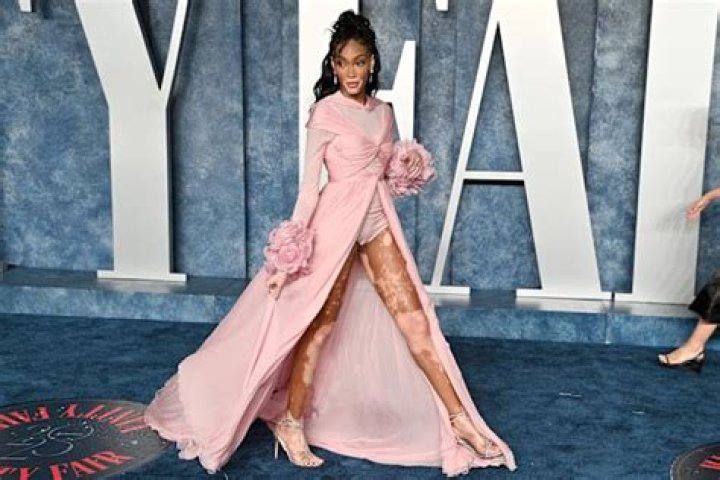 An Inspiration! Winnie Harlow Poses Nude for a Magazine to Show Her Vitiligo!