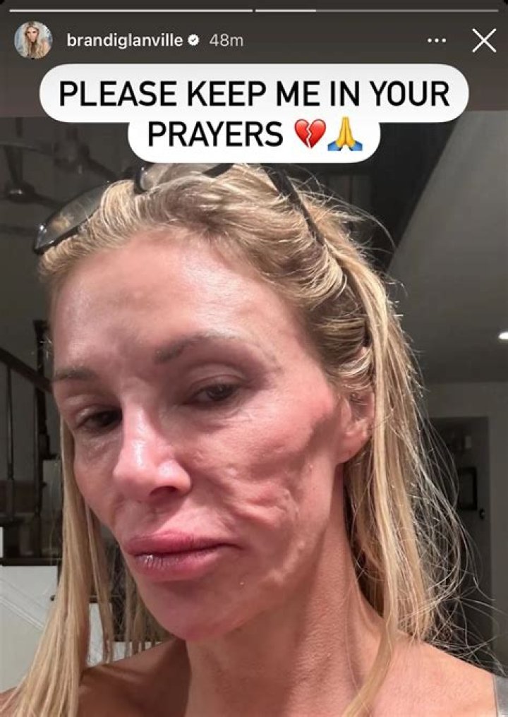 Brandi Glanville tweets photo of her burned face, says she’s ‘still healing’