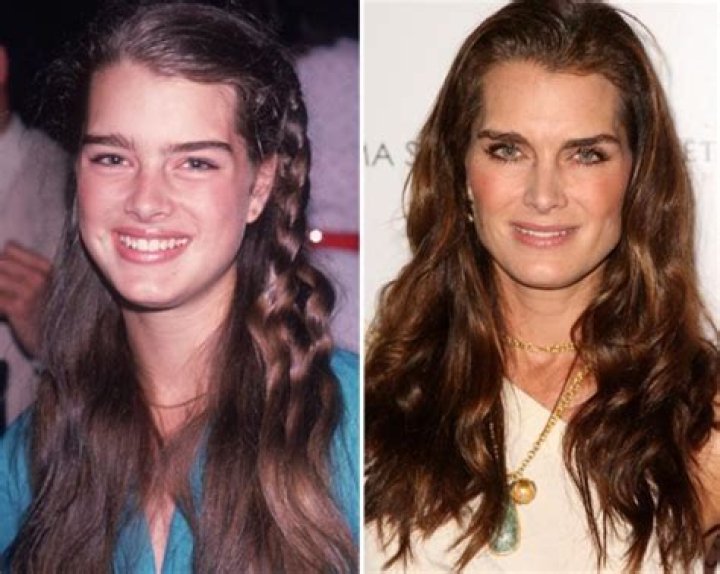 Brooke Shields Nose Job, Plastic Surgery Before And After