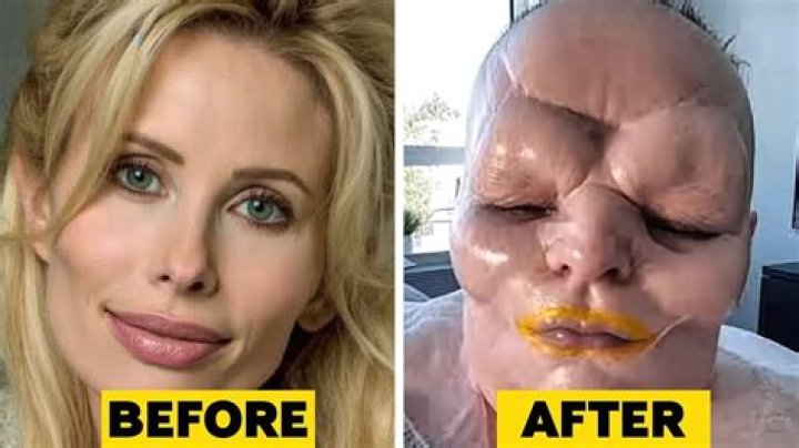 Chloe Lattanzi feels ‘ridiculous, mutilated’ after excessive plastic surgery