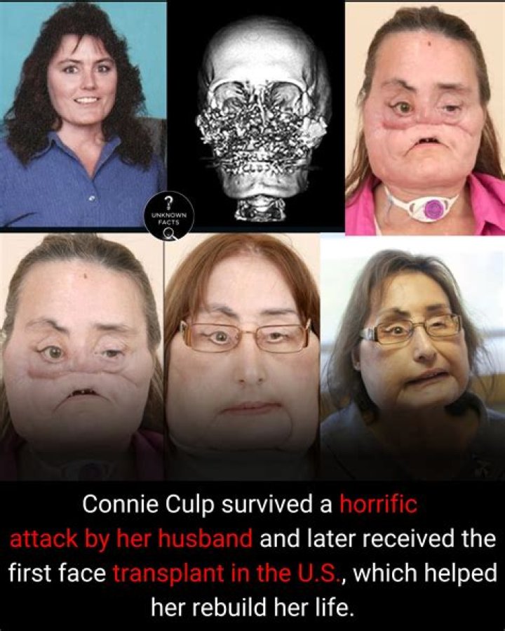 Connie Culp, the first USA face transplant patient dies at age 57!