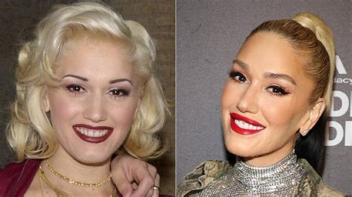 Gwen Stefani Face Lift: Plastic Surgery Before And After