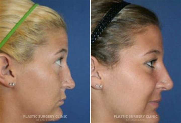 Herlene Nicole Budol New Look and Nose After Rhinoplasty, Before And After Plastic Surgery Photos