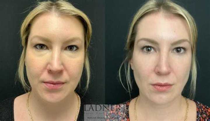 Ines Rau Plastic Surgery: Before And After Looks