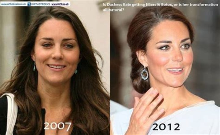 Is Duchess Kate getting fillers & Botox, or is her transformation all-natural?