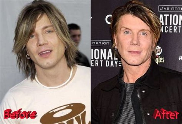 John Rzeznik Facelift: Goo Goo Dolls Frontman Plastic Surgery Before And After