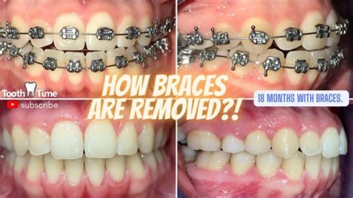 Randy Orton Missing Teeth Case: Is He Toothless Now? Used Braces