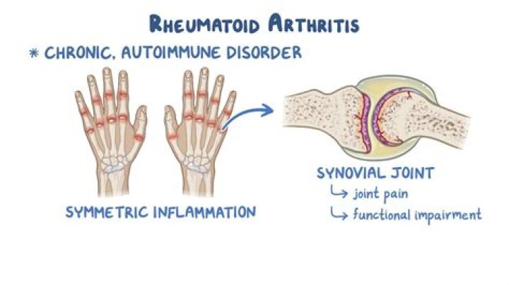 Tatum O’Neal opens up about rheumatoid arthritis: I can’t tie my shoes