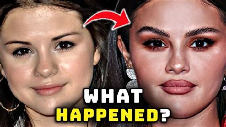 What Happened To Selena Gomez Face? Surgery, Before After And Health Condition