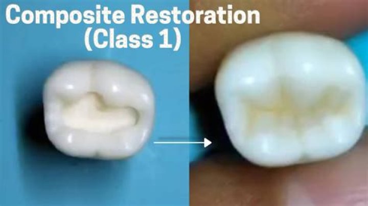 What is a Class 1 dental restoration?