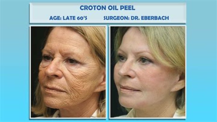 What is Croton oil peel?