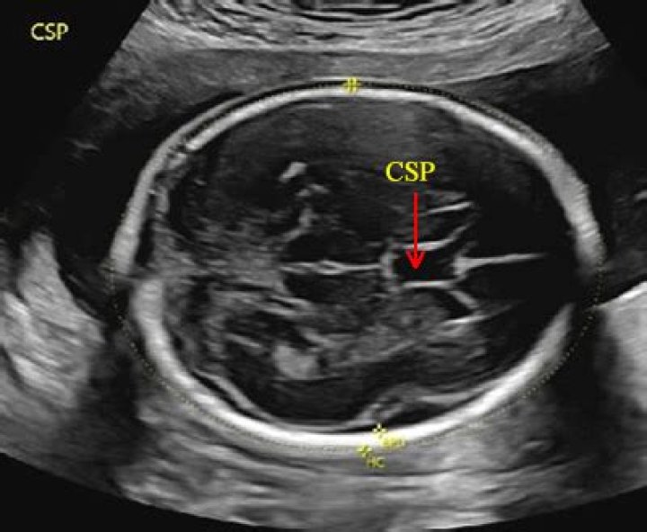 What is CSP in fetus?