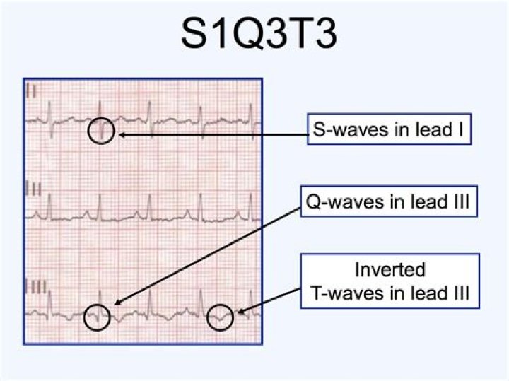 What is s1q3t3 in ECG?