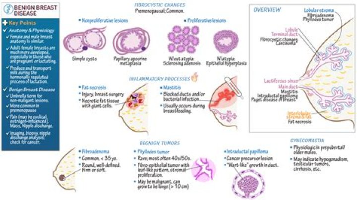 Which condition is a benign tumor formed from glandular tissue?